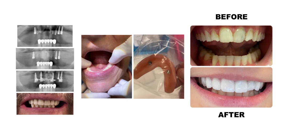 Before and After Dental Implants