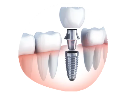 Dental Implants