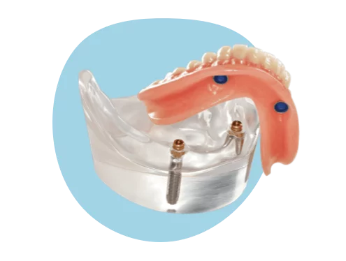 Overdenture